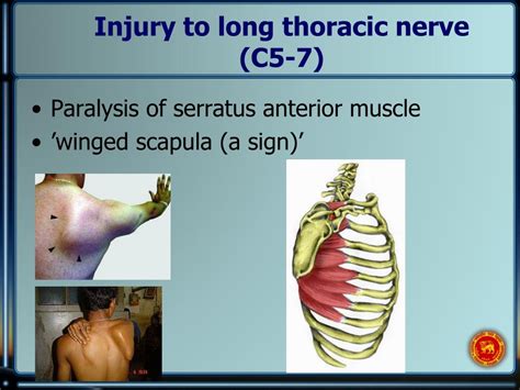 Ppt Clinical Correlation Of Peripheral Nerve Injuries Of Limbs