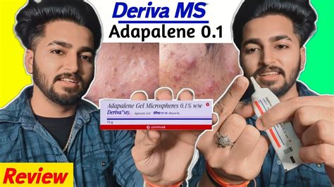 Blackheads Acne Removal Adapalene Gel Deriva MS Gel Review YouTube