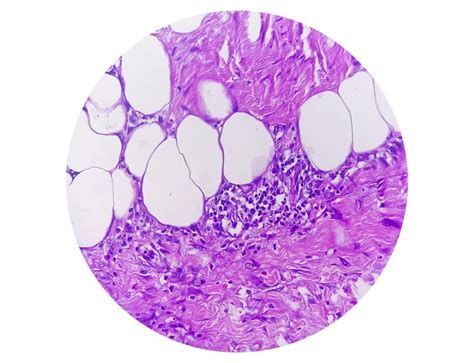 Premium Photo | Photomicrograph of granulomatous tissue histology showing foreign body granuloma