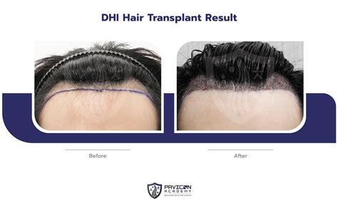 Dhi Hair Transplant Pavicon Mediness Center