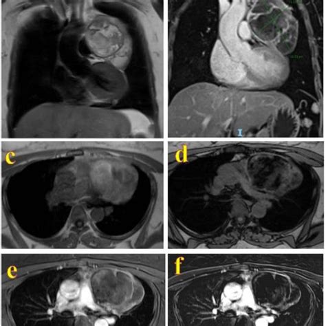 Case 2 Mediastinal Mature Cystic Teratoma In A 35 Year Old Woman