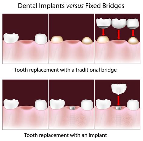 Dental Bridge VS Implant An In Depth Comparison Of Cost Benefits