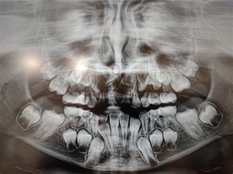 La Importancia De Realizar Radiograf As A Los A Os Centre Dental M