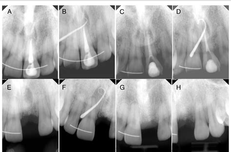 Figure 1 From Misdiagnosis Of A Nasopalatine Duct Cyst A Case Report