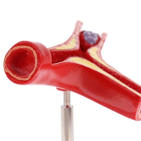 Human Atherosclerosis Cardiovascular Model Suppliers And Manufacturers