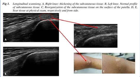 Figure 1 From Ultrasound Imaging Of A Scar On The Knee Sonopalpation