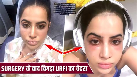 Eye Filler Surgery Ke Baad Bigda Urfi Javed Ka Chehra Urfi Ne Share Ki