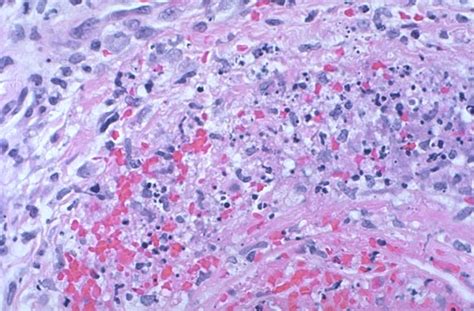 Pathology Outlines Vasculitis Includes Leukocytoclastic