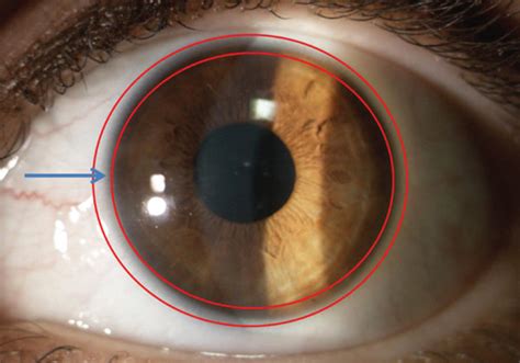 Limbal Stem Cells Are Located On The Basal Epithelium In The Limbal