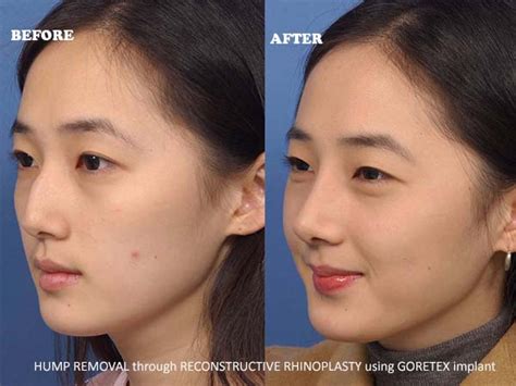 Reconstructive Rhinoplasty Using Gore Tex Implant Montesa Medical Group