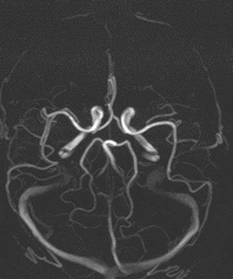 Phase Contrast Mri Physics Techniques And Clinical Applications