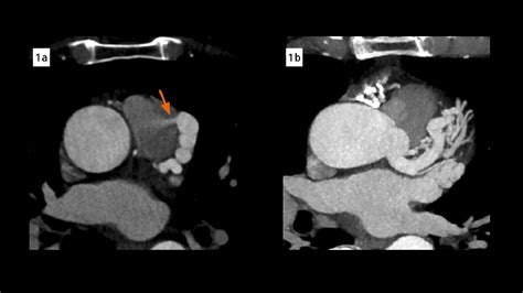 A Complex Coronary Arteriovenous Fistula Siemens Healthineers Usa