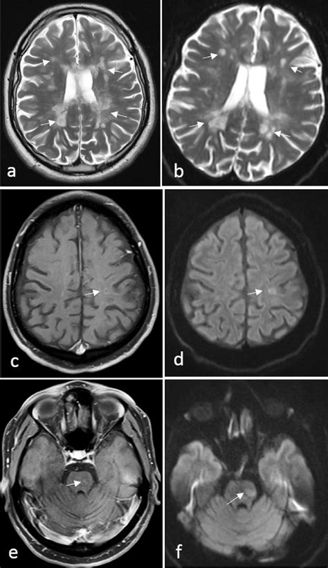 Af A Axial T Wi B Axial Dwi B Showed Multiple Bright Lesions