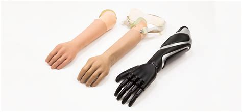 Components Of A Bionic Arm Prosthesis Aether Biomedical