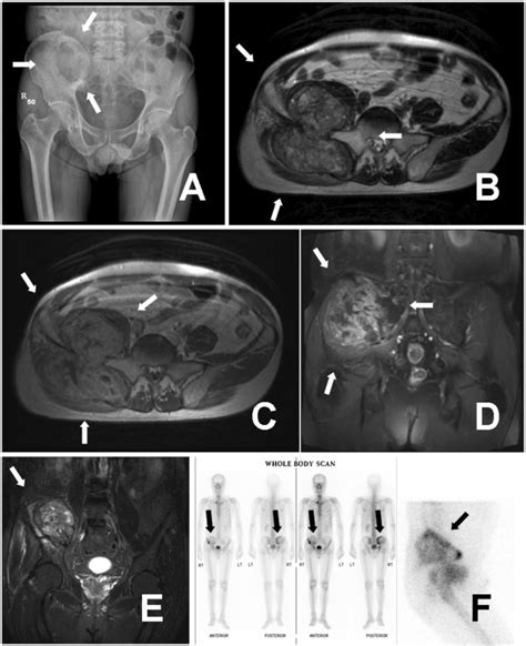 Pelvis radiograph showed a large osteolytic lesion over right iliac ...