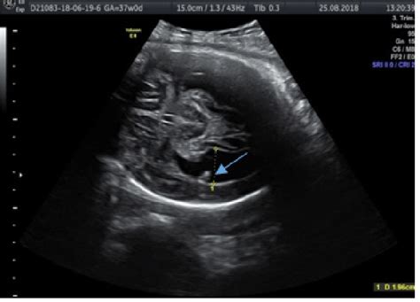 35 Weeks Fetus Ultrasound