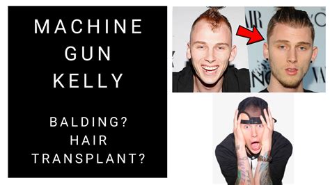 Did Machine Gun Kelly Have A Hair Transplant Celebrity Hair