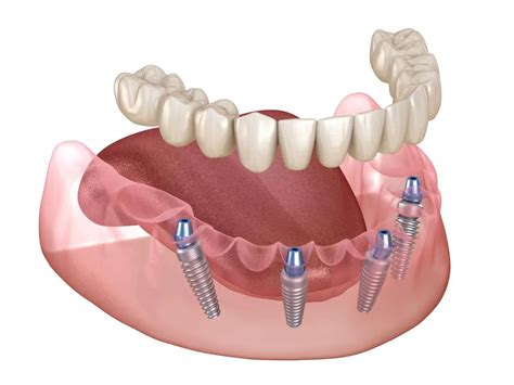 What Are The Risks Or Complications With Full Mouth Dental Implants Elevate Dental Temecula