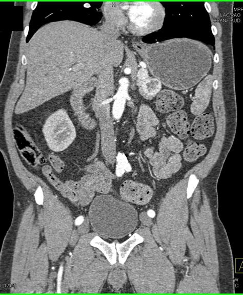 Recurrent Renal Cell Carcinoma Rcc With Pancreas And Bone Metastases