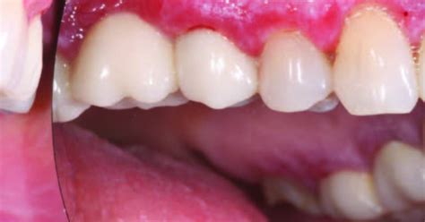 Demystifying Desquamative Gingivitis Diagnosis And Management