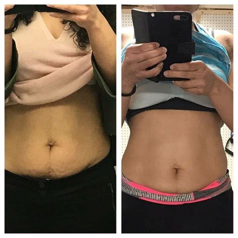 Before And After Pictures Of Stomach Area From Using Tummy Tuck Cream Natural Skin Tightening