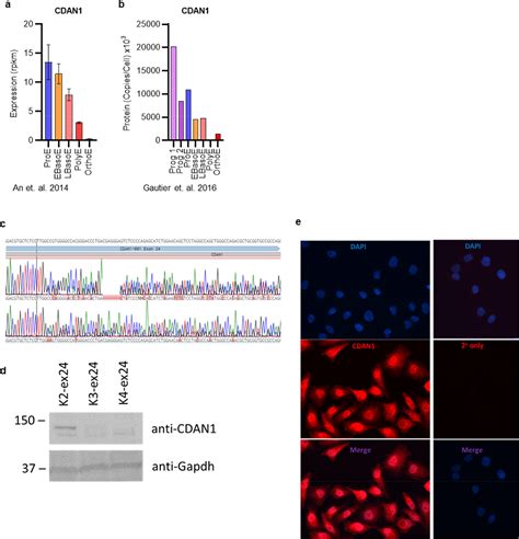 Codanin Mutations Engineered In Human Erythroid Cells Demonstrate