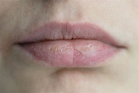 Herpes Lips