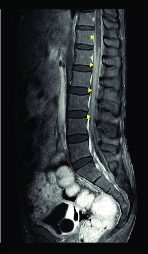 MRI revealing spinal meningeal enhancement surrounding the conus ...