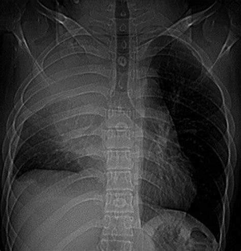 Chest X Ray Posterior Anterior View Showing Rightsided Homogeneous