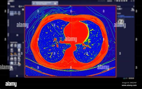 Tomografía computarizada de tórax Vista axial en modo color para