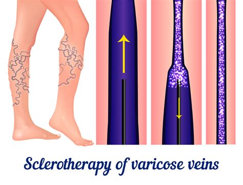 How long does it take to recover from varicose vein surgery? - Dekalb ...