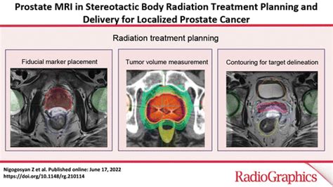 Prostate Mri In Stereotactic Body Radiation Treatment Planning And Delivery For Localized