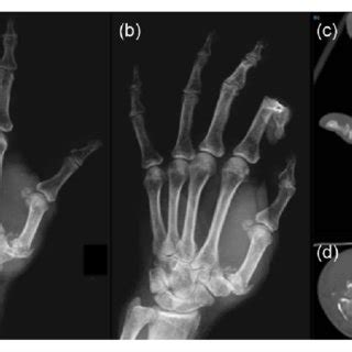 A Anteroposterior And B Lateral Radiographs Of The Hand