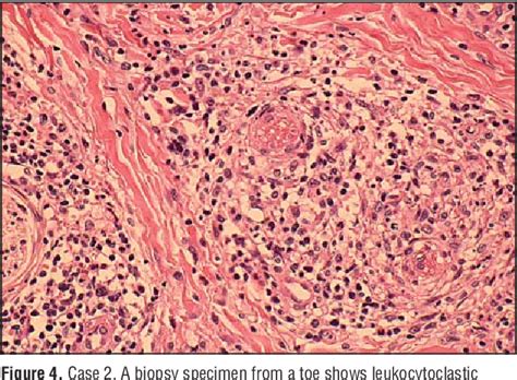 Figure From Initial Cutaneous Manifestations Consistent With