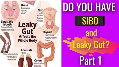 Sibo Vs Leaky Gut Whats The Difference And How To Heal Youtube