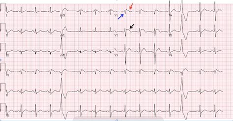 Type 1 Brugada Syndrome - JETem