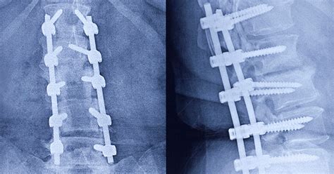 Percutaneous Instrumentation And Pedicle Screws Atlanta Ga Spine