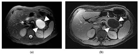 Pancreatic Cystic Lesion Body Mri Hot Sex Picture