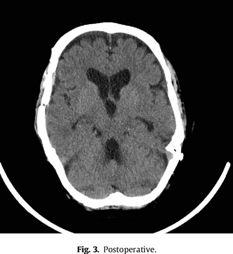 Figure From A Rare Case Of Tension Pneumocephalus After Head Trauma