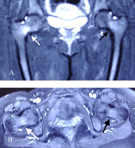 Preoperative T Weighted Mri Images Of Both Hips A Coronal View B