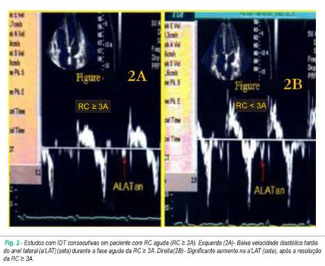 SciELO Brasil Ecocardiografia por Doppler tecidual no diagnóstico