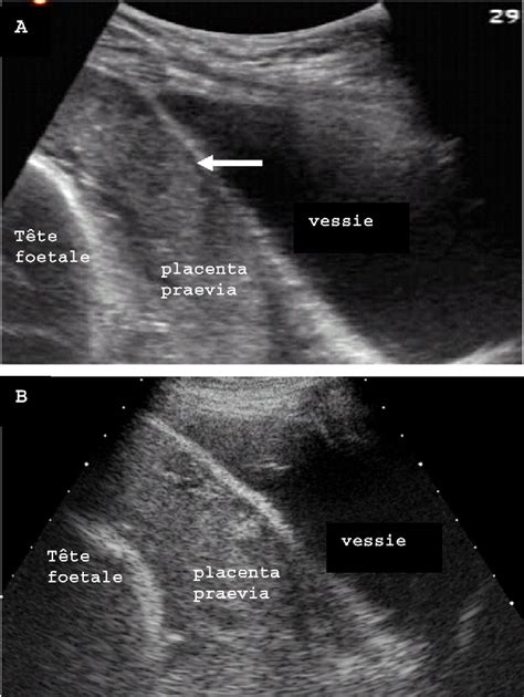 Placenta Previa Ultrasound