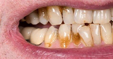 13 Causes Of Sudden Brown Stains Between Teeth And Treatment