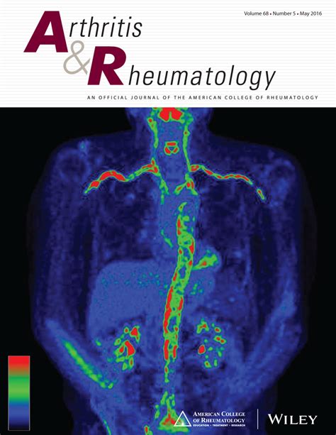 X Chromosome Dose And Sex Bias In Autoimmune Diseases Increased Prevalence Of 47xxx In