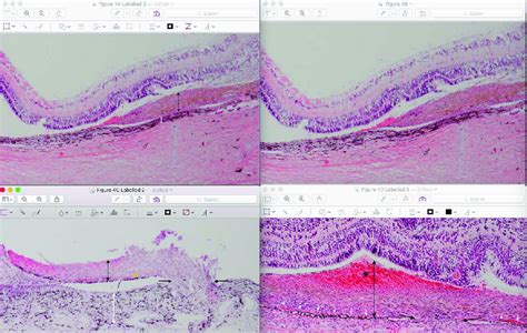 Choroidal Neovascular Membrane Diagram