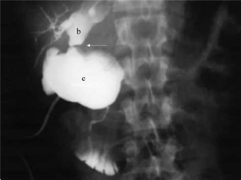 T Tube Cholangiography Showing The Choledochal Cyst C The