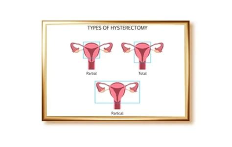 A Hysterectomy Treatment Options For Womens Health Conditions