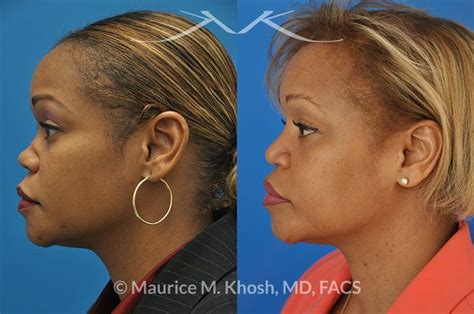 New York Facial Plastic Surgery Saddle Nose Repair Before And After Pictures