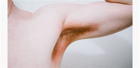 Armpit Rashes Causes Symptoms And How To Treat Them 58 Off