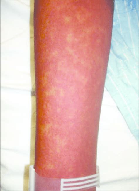 Toxic Shock Syndrome Skin Rash